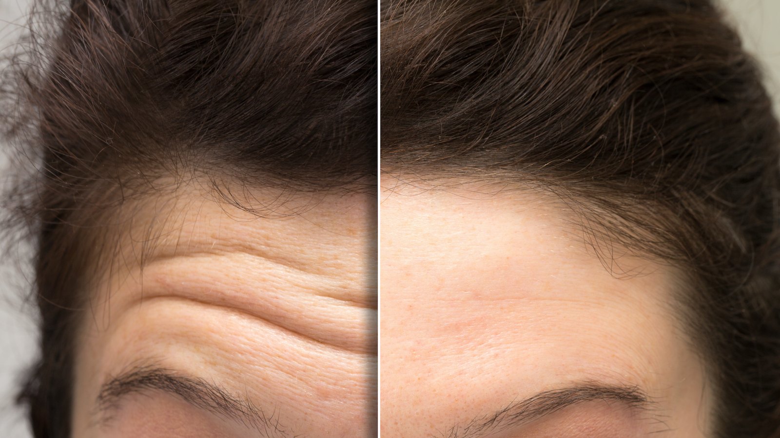 Forehead-Lines-Before-After