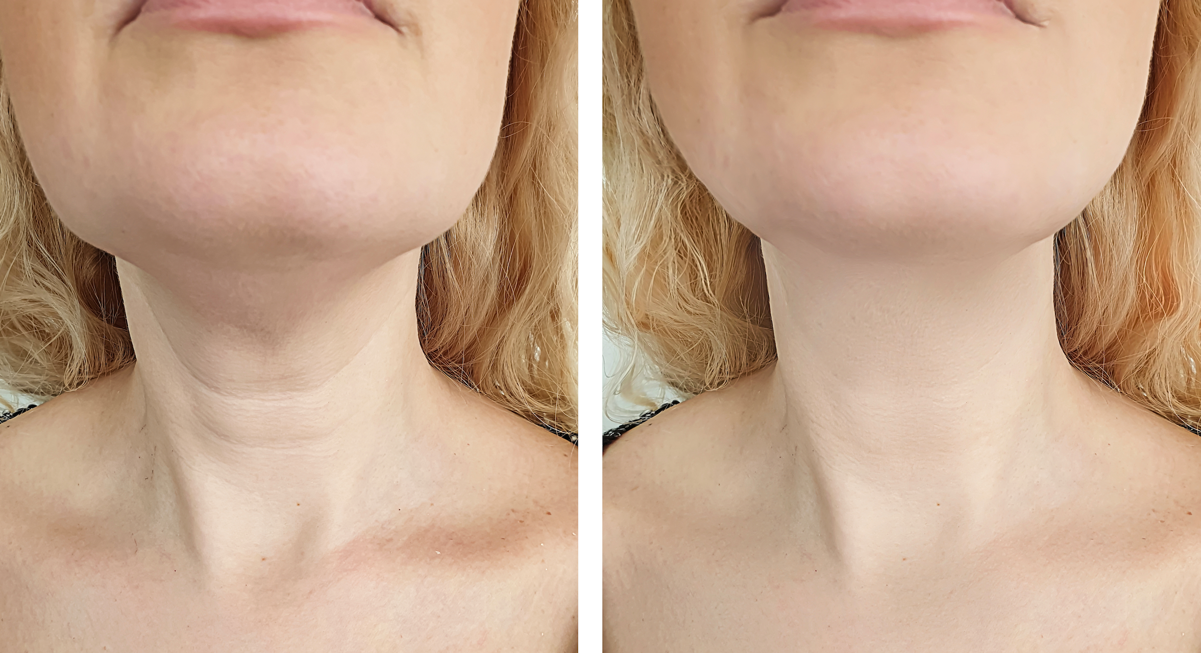 Dermelect Firming Cream May Help Tackle Crepey Skin and Neck Lines
