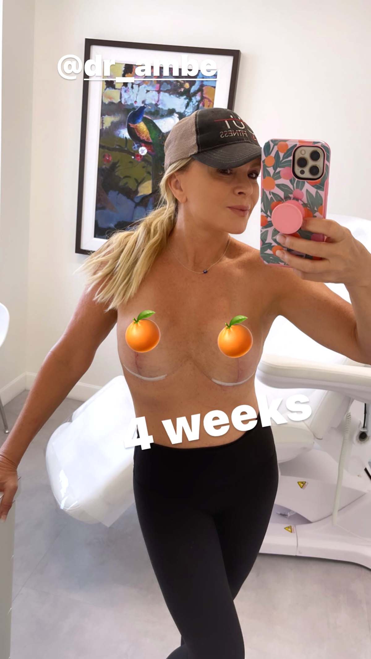 RHOCs Tamra Judge Shares Topless Pic 4 Weeks After Implant Removal