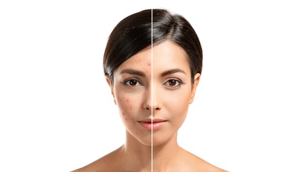 acne-elixir-pimple-before-after