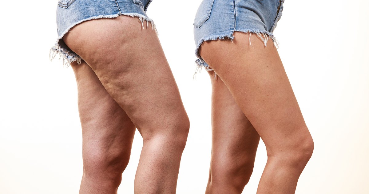 This  Anti-Cellulite Cream Is A Secret Amazon Hit