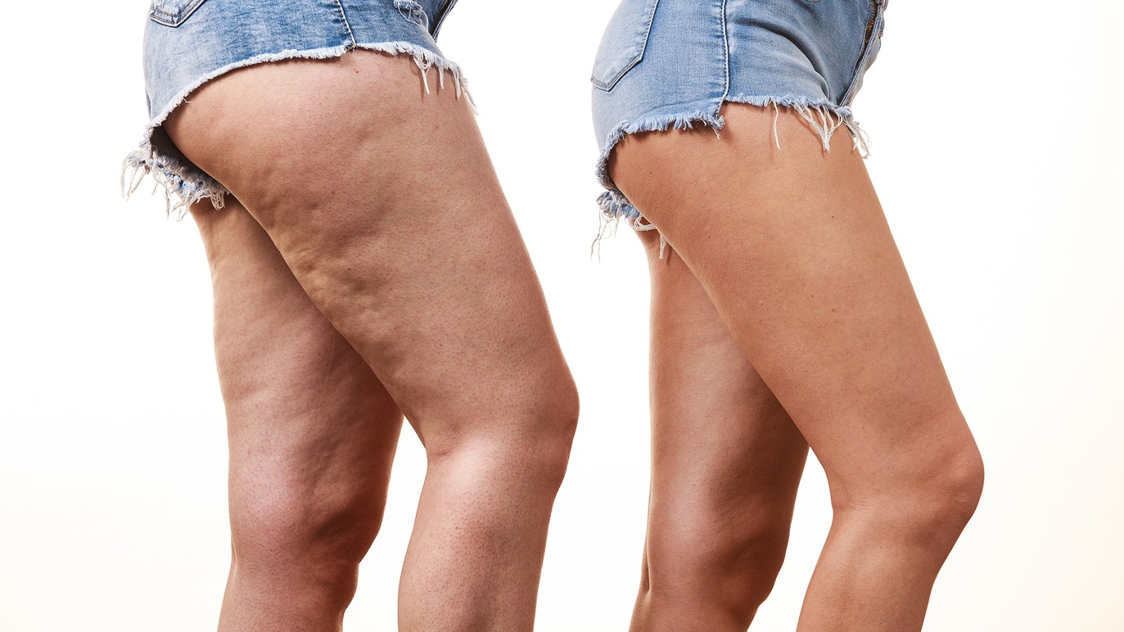 cellulite-before-after