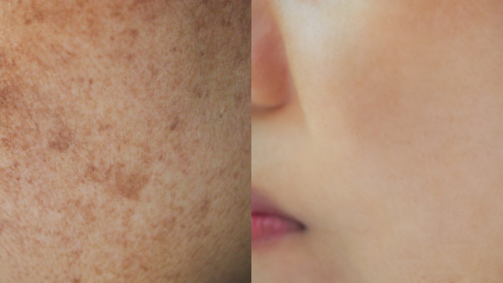 dark-spots-before-after