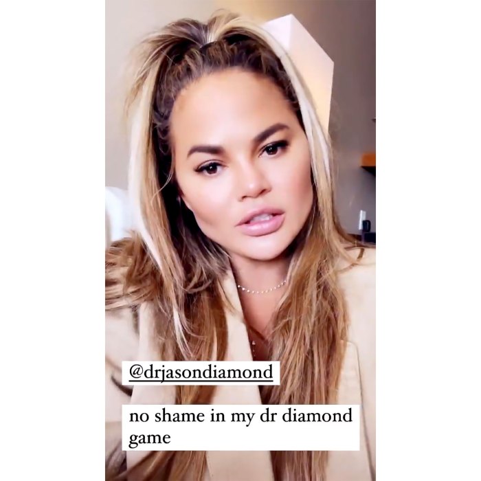 Chrissy Teigen Reveals the Results of ‘Fat Removal’ Surgery on Her Face