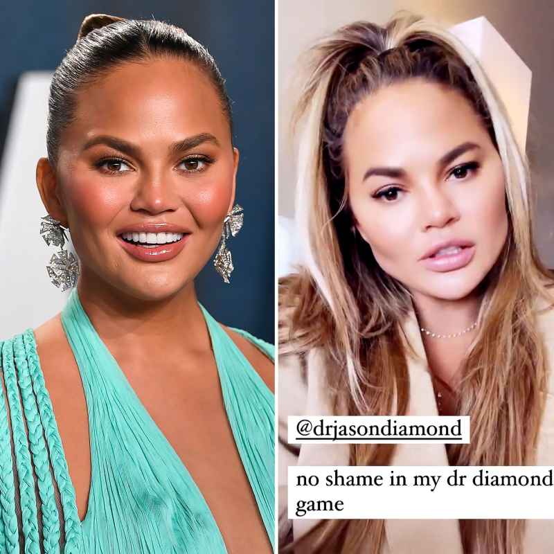 Chrissy Teigen Reveals the Results of ‘Fat Removal’ Surgery on Her Face