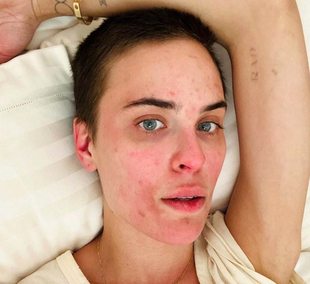 How Talulah Willis Went From Chronic Picker Having Supple Skin