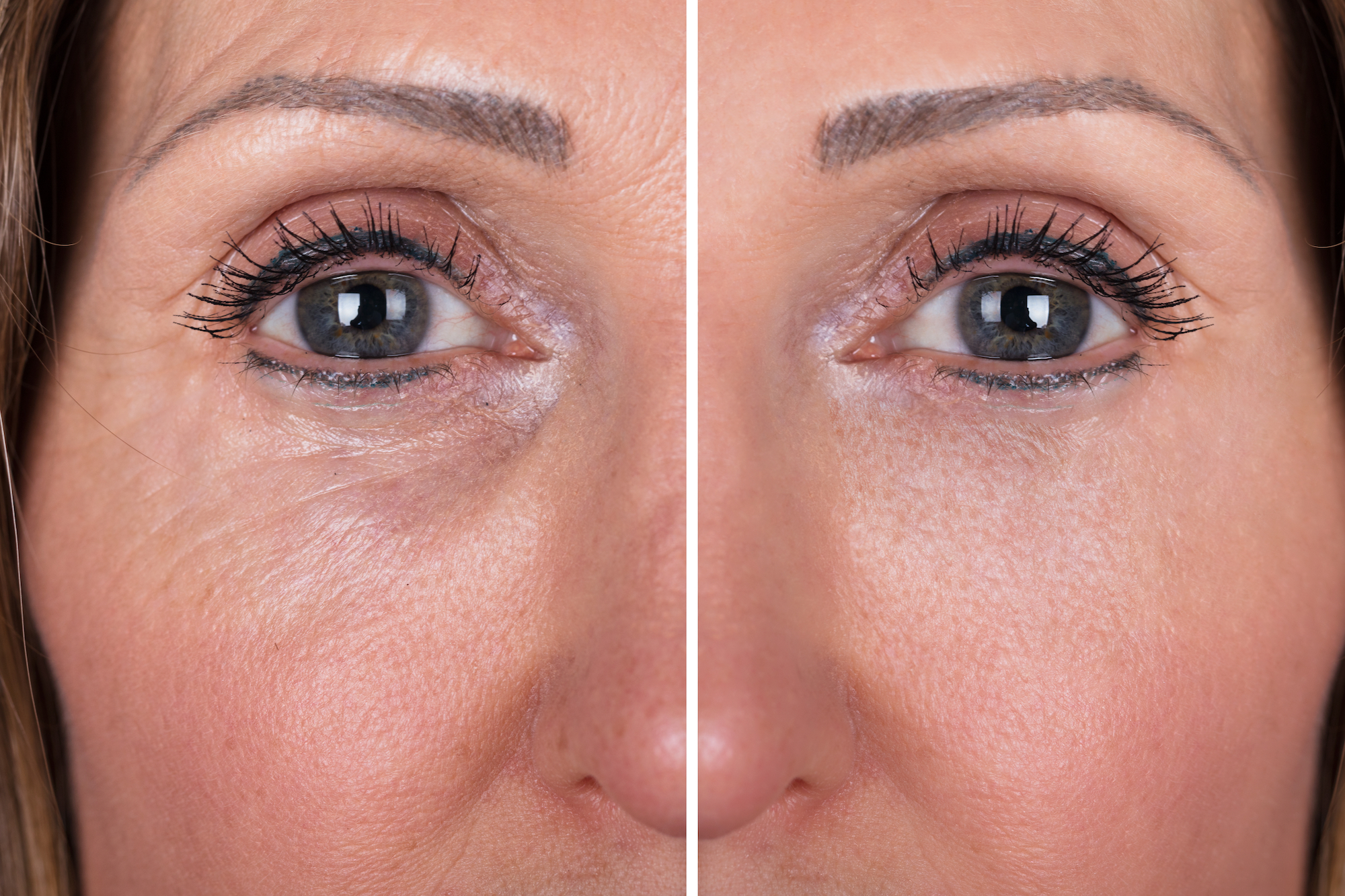Wrinkle-Treatment-Before-After