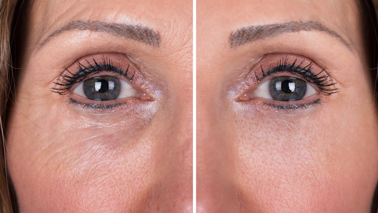 Wrinkle-Treatment-Before-After