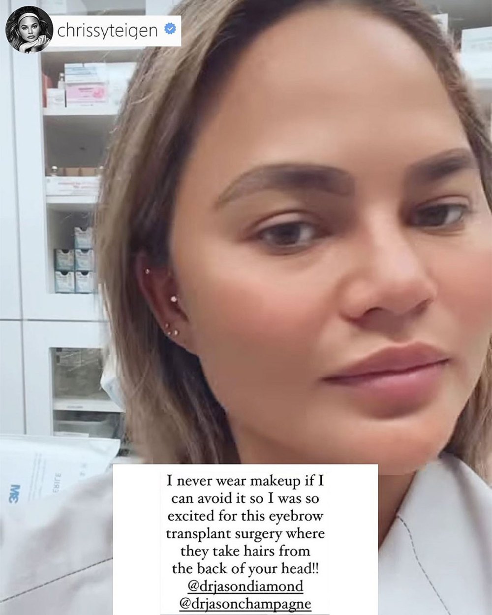 Chrissy Teigen Asks Why Eyebrow Transplant Has People Riled Up