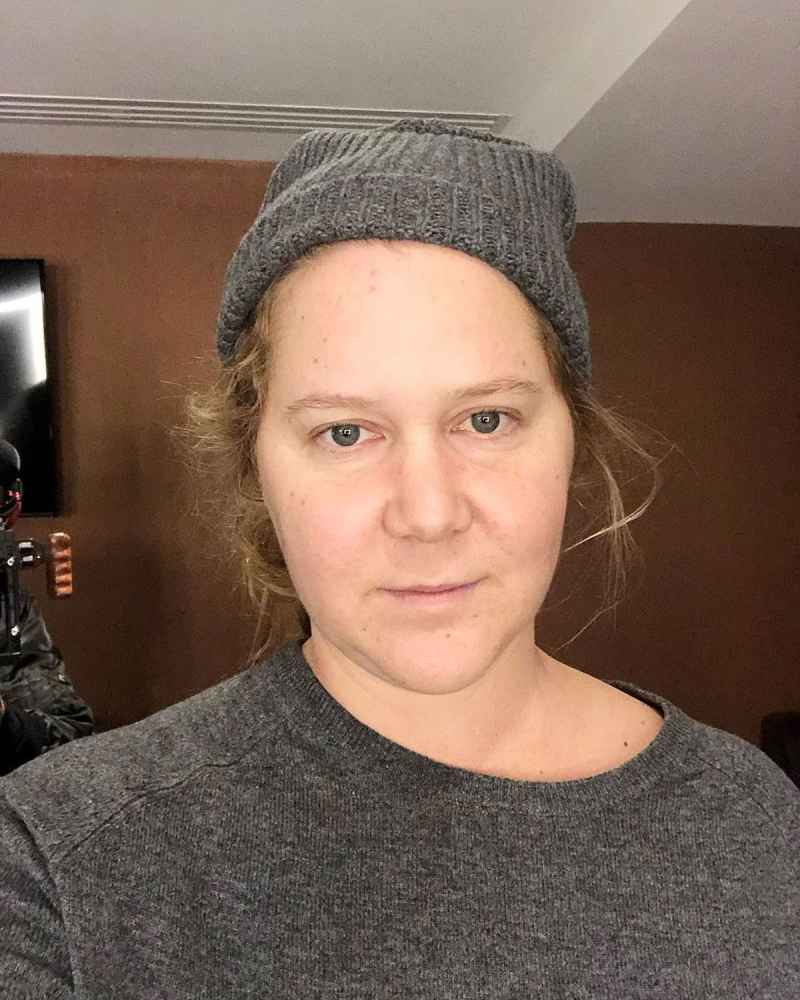 Amy Schumer Shows Off Makeup Free Complexion After Dissolving Fillers