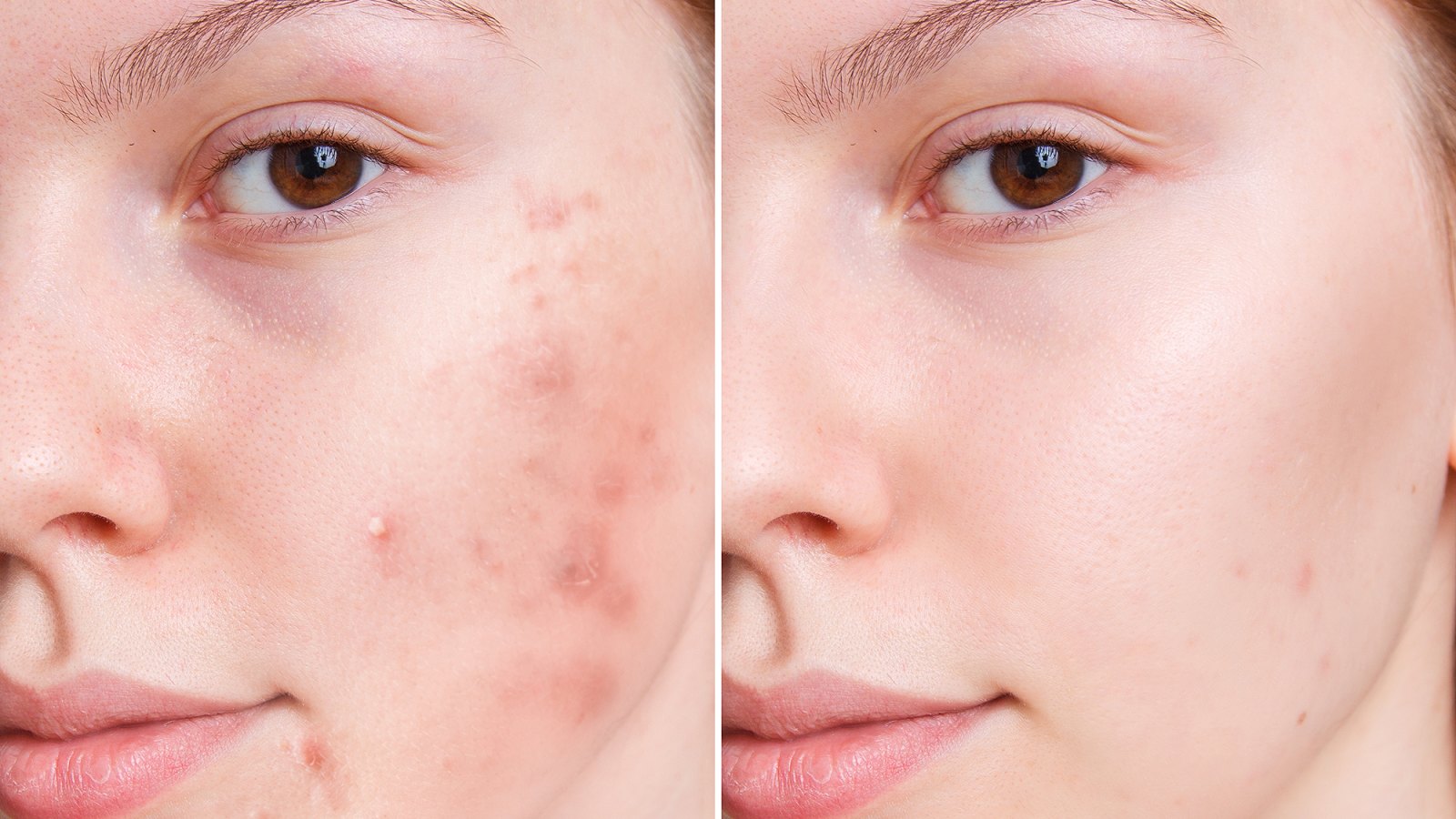 acne-before-after
