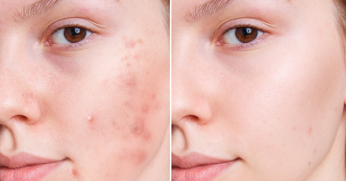 acne-before-after.jpg?w=1200&h=630&crop=1&quality=86&strip=all