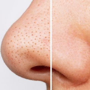 blackheads-before-after-mario-badescu-silver-powder