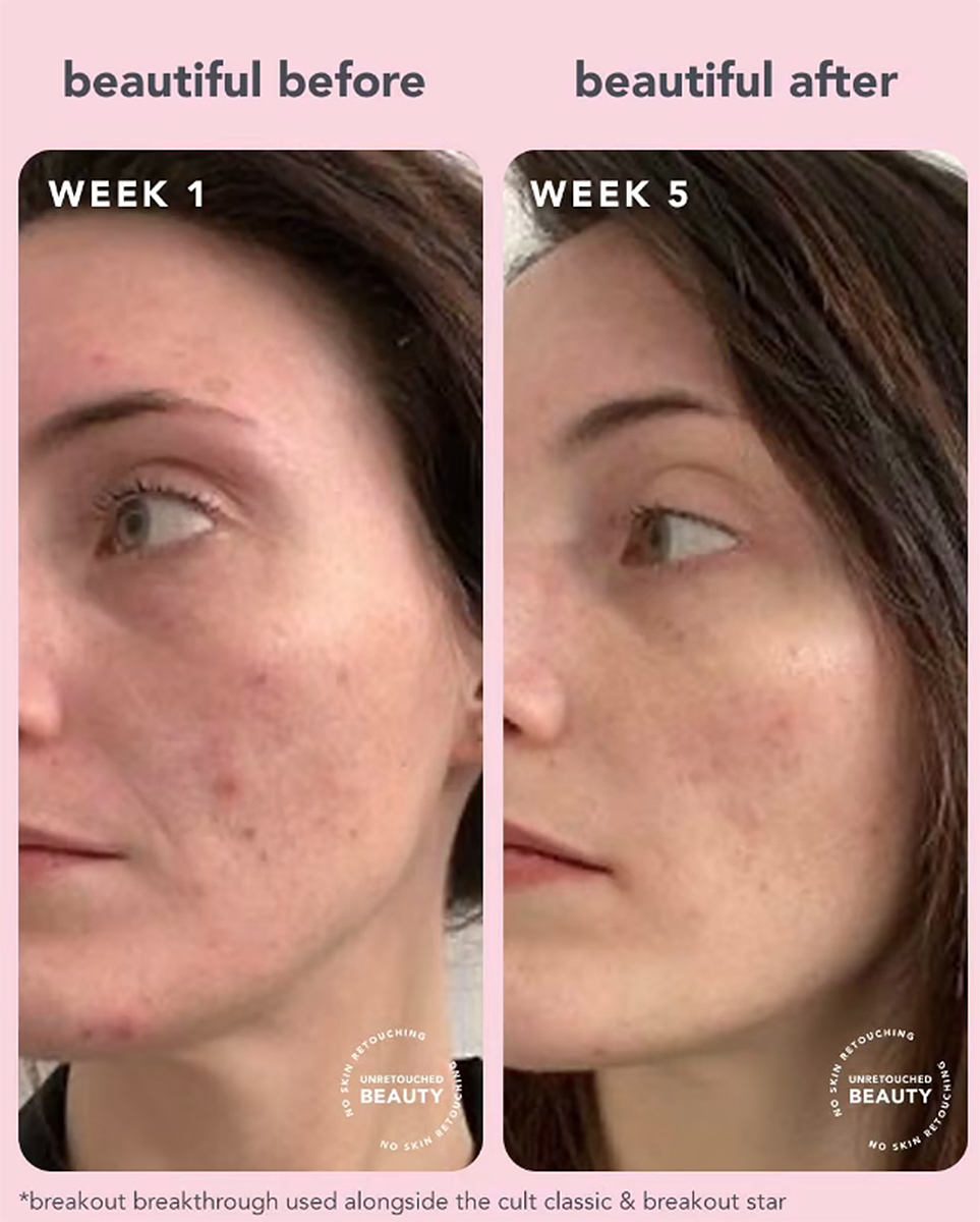 tula-breakout-breakthrough-toner-pads-before-after