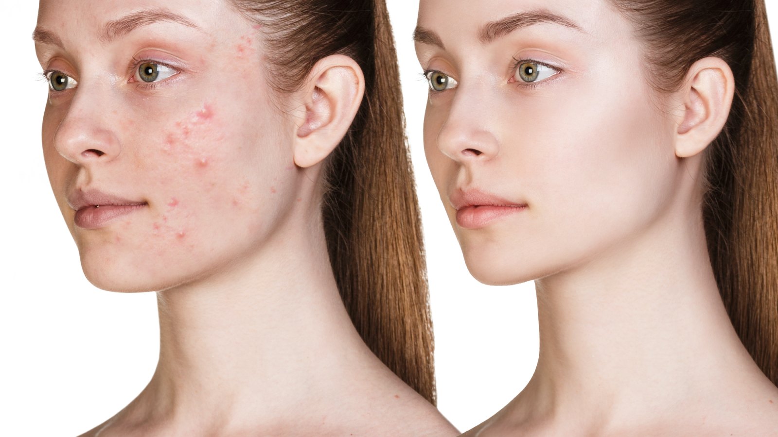 Before-After-Acne-Treatment-Stock-Photo