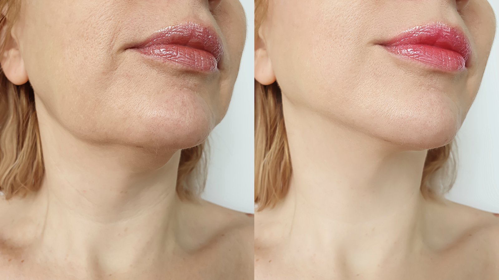 Neck-Lift-Before-and-After-Stock-Photo