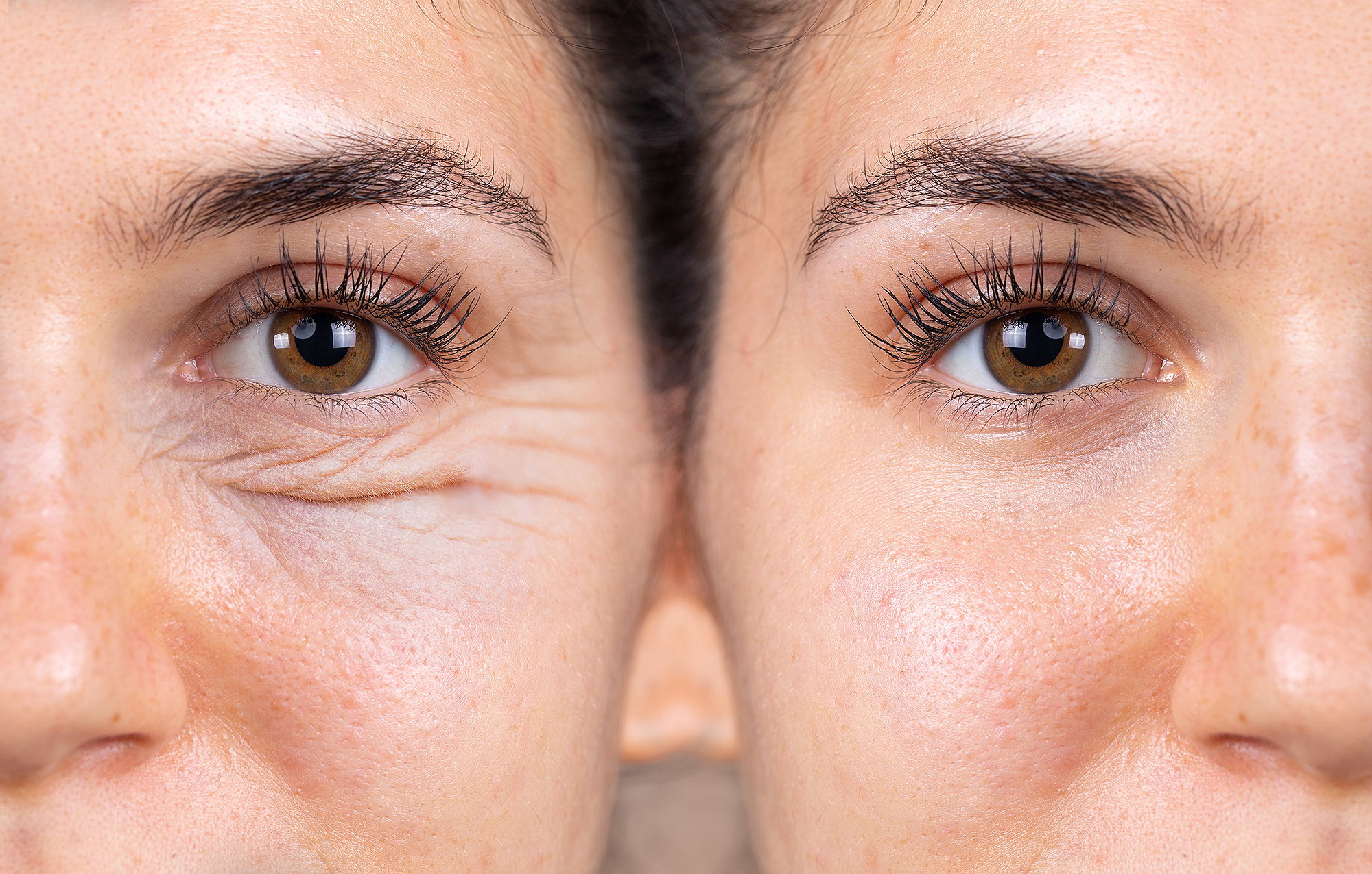 7 Ways to Get Rid of Under Eye Bags - Millennial Plastic Surgery