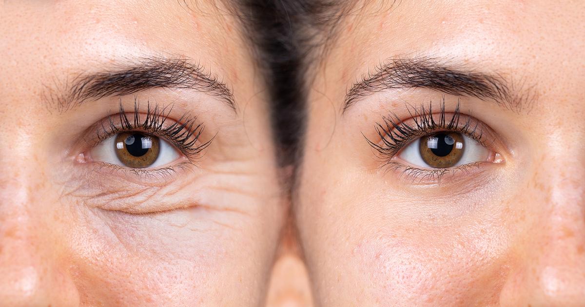Wealthskin Anti-Aging Eye Cream Results in