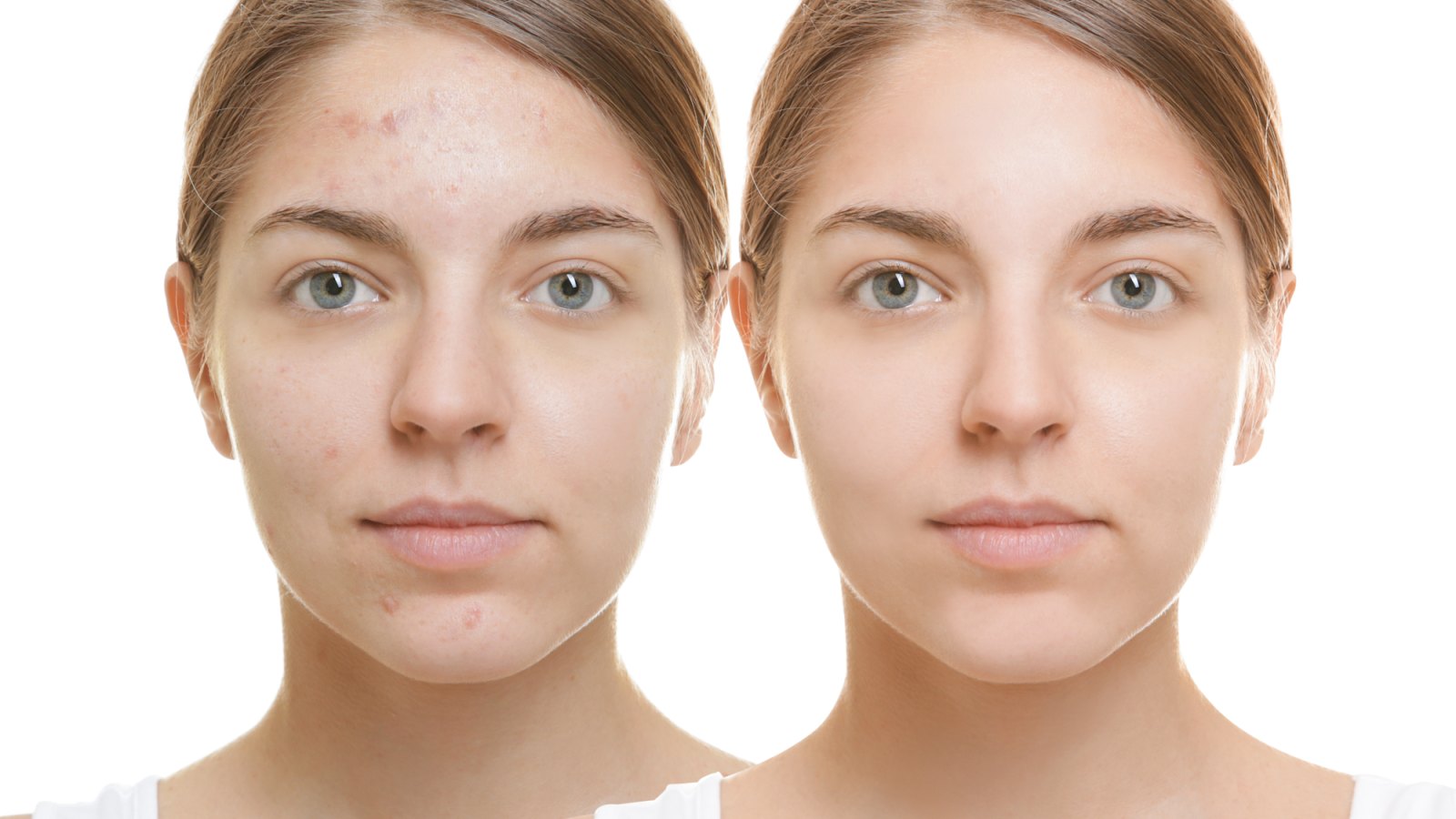 Before-After-Acne-Scarring-Stock-Photo