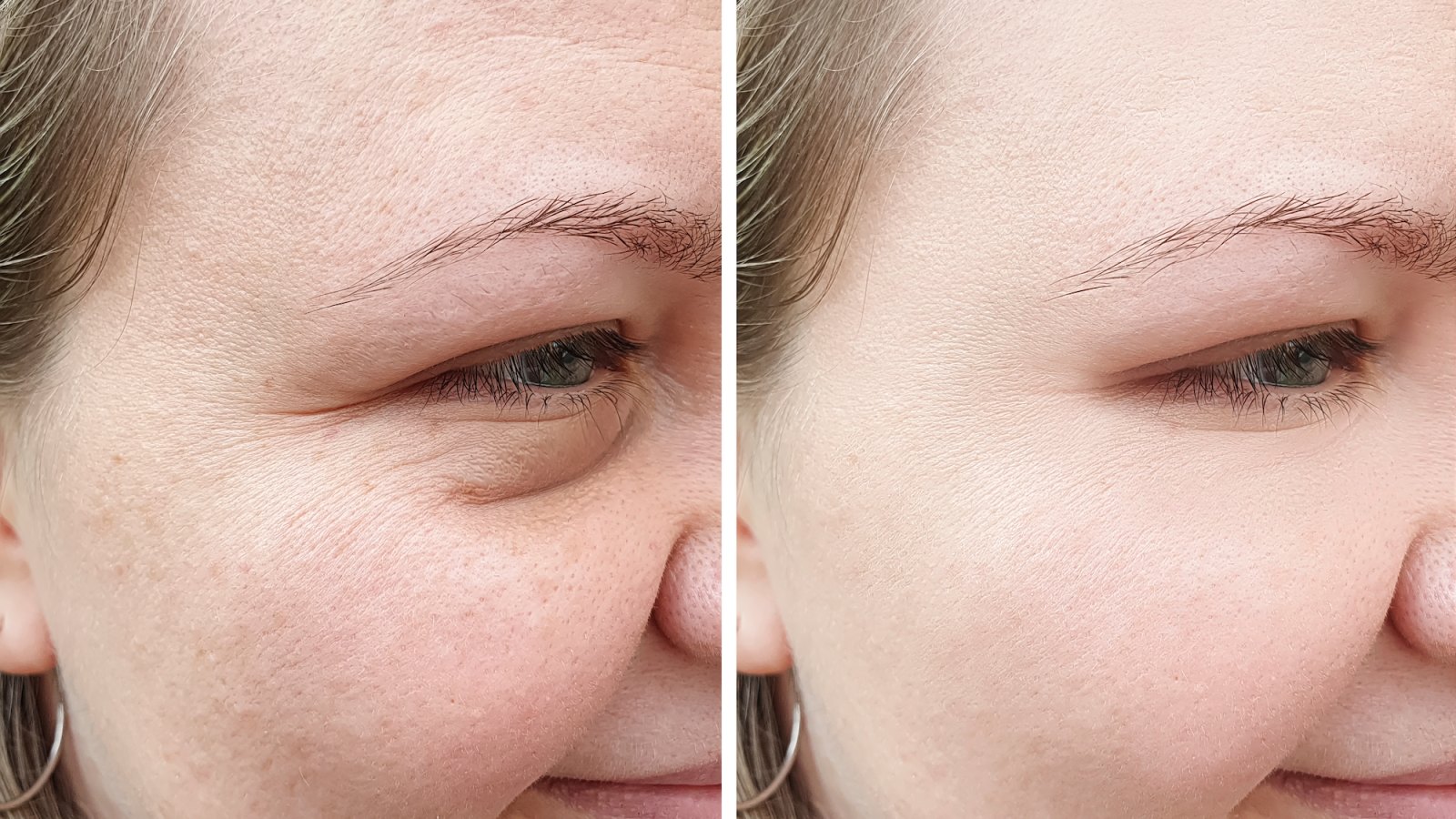 Before-and-After-Skin-Treatment-Stock-Photo