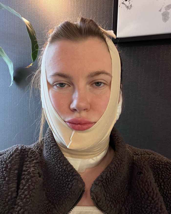 Ireland Baldwin Defends Her Decision to Get Plastic Surgery Instagram