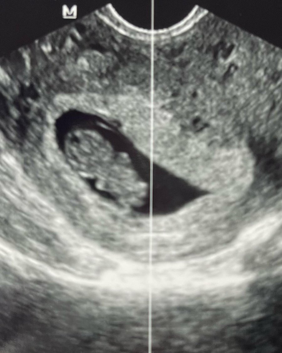 Sneak-Peeks-Staci-Felker-and-More-Pregnant-Stars-Show-Ultrasound-Pics