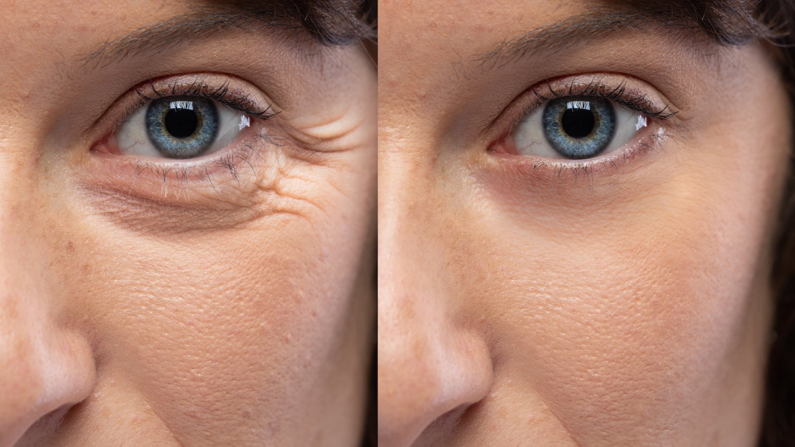 Before-After-Crows-Feet-Treatment-Stock-Photo