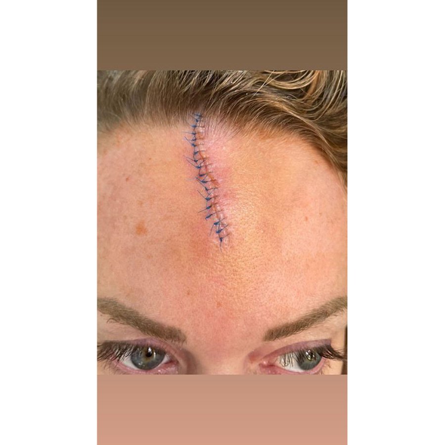 On Having a Forehead Scar for Her Wedding MLB Reporter Kelsey Wingert to Wed in 11 Days Will Have Scar for Wedding After Foul Ball Incident