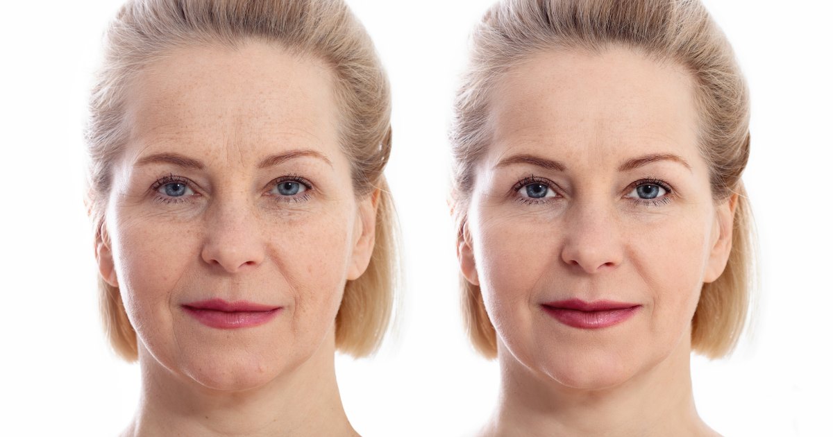 Before After Facelift Stock Photo