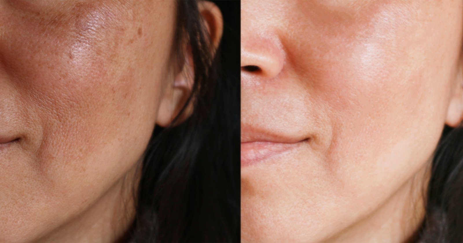 Brightening-Treatment-Before-After