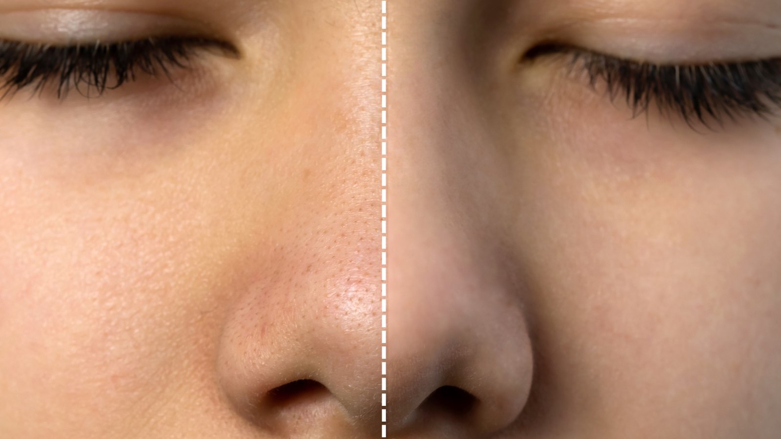 Before-After-Pore-Treatment-Stock-Photo