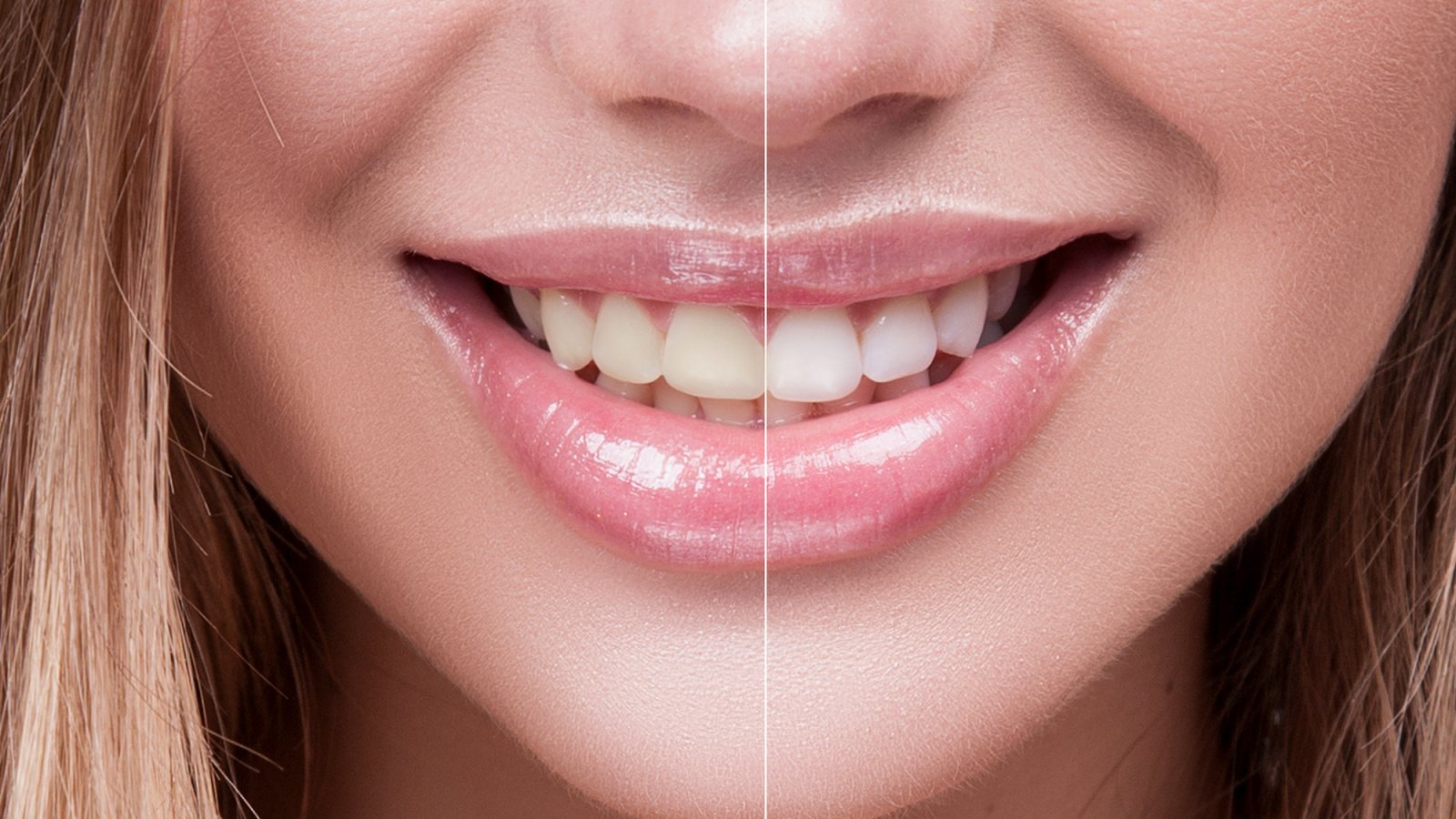 Before-After-Teeth-Whitening-Stock-Photo