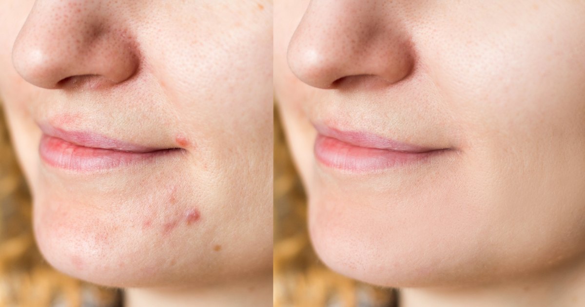 Derma E Scar Gel Might Assist Get Rid of Deep Rooted Zits Scars Derma E Scar Gel Might Assist Get Rid of Deep Rooted Zits Scars