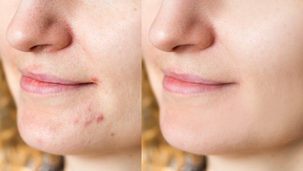 Before-After-Acne-Scarring-Stock-Photo