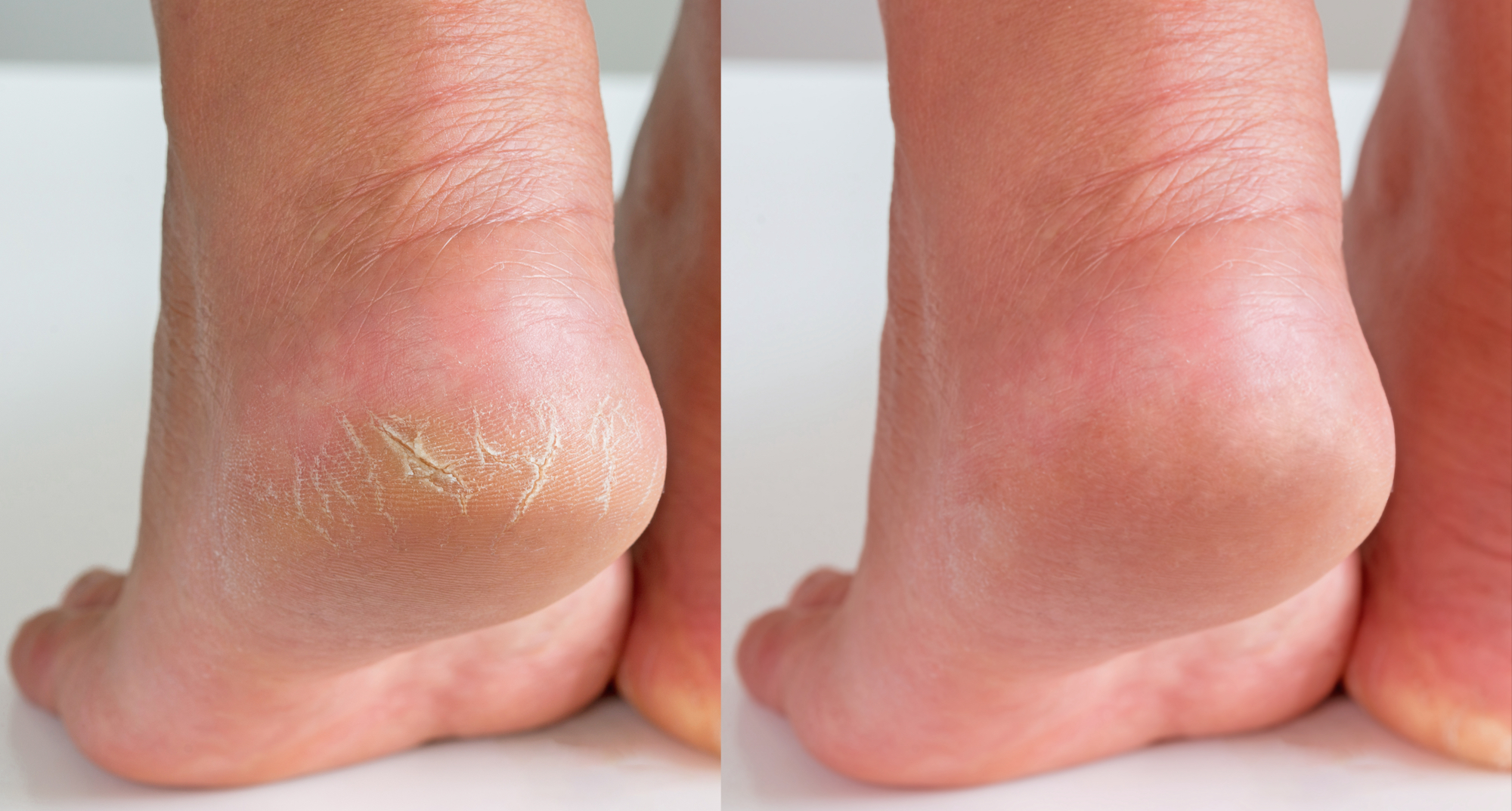How to treat cracked heels! | Daily Sun