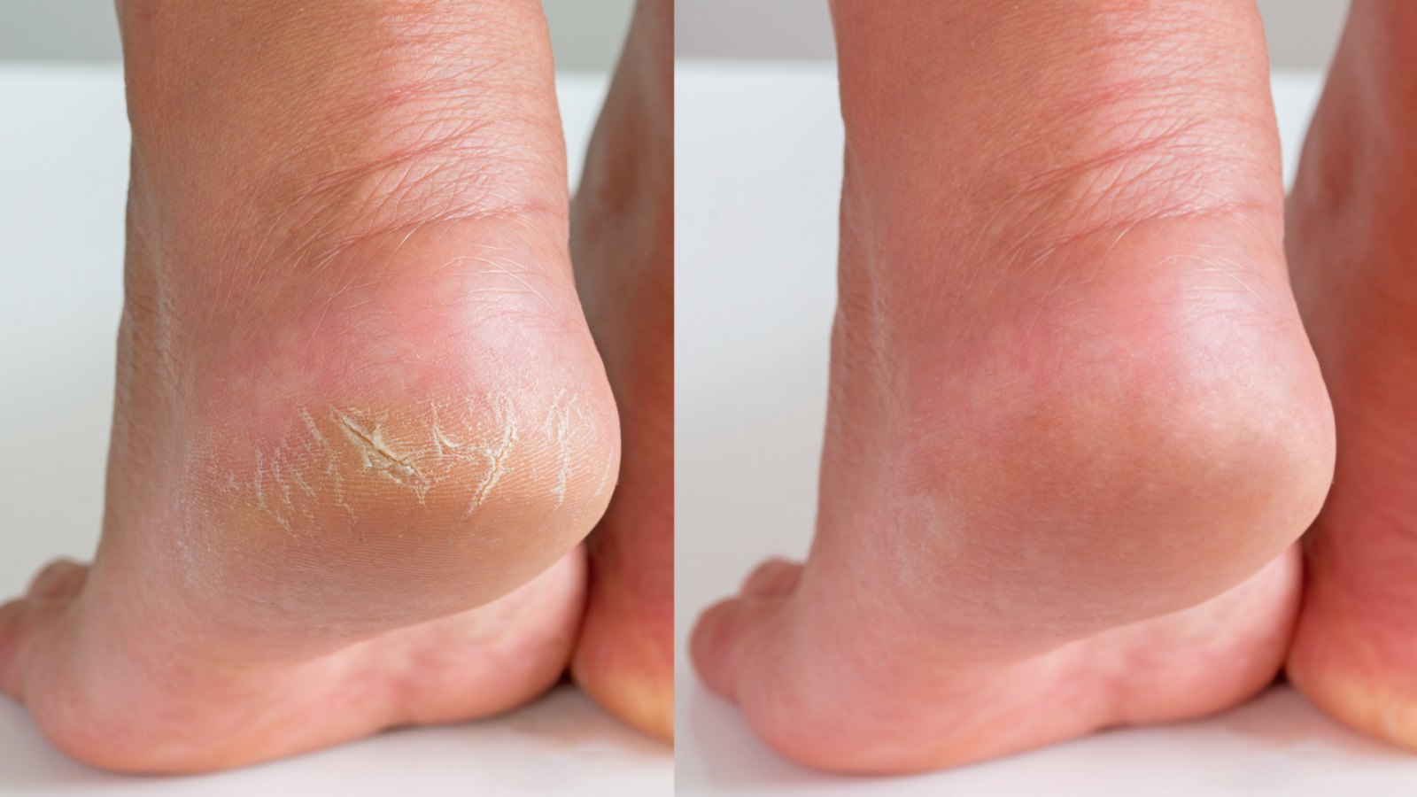 Top 7 Home Remedies to Remove Thick Dead Skin from Feet