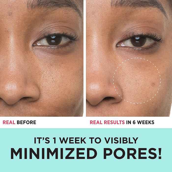 amazon-bye-bye-pores-before-after