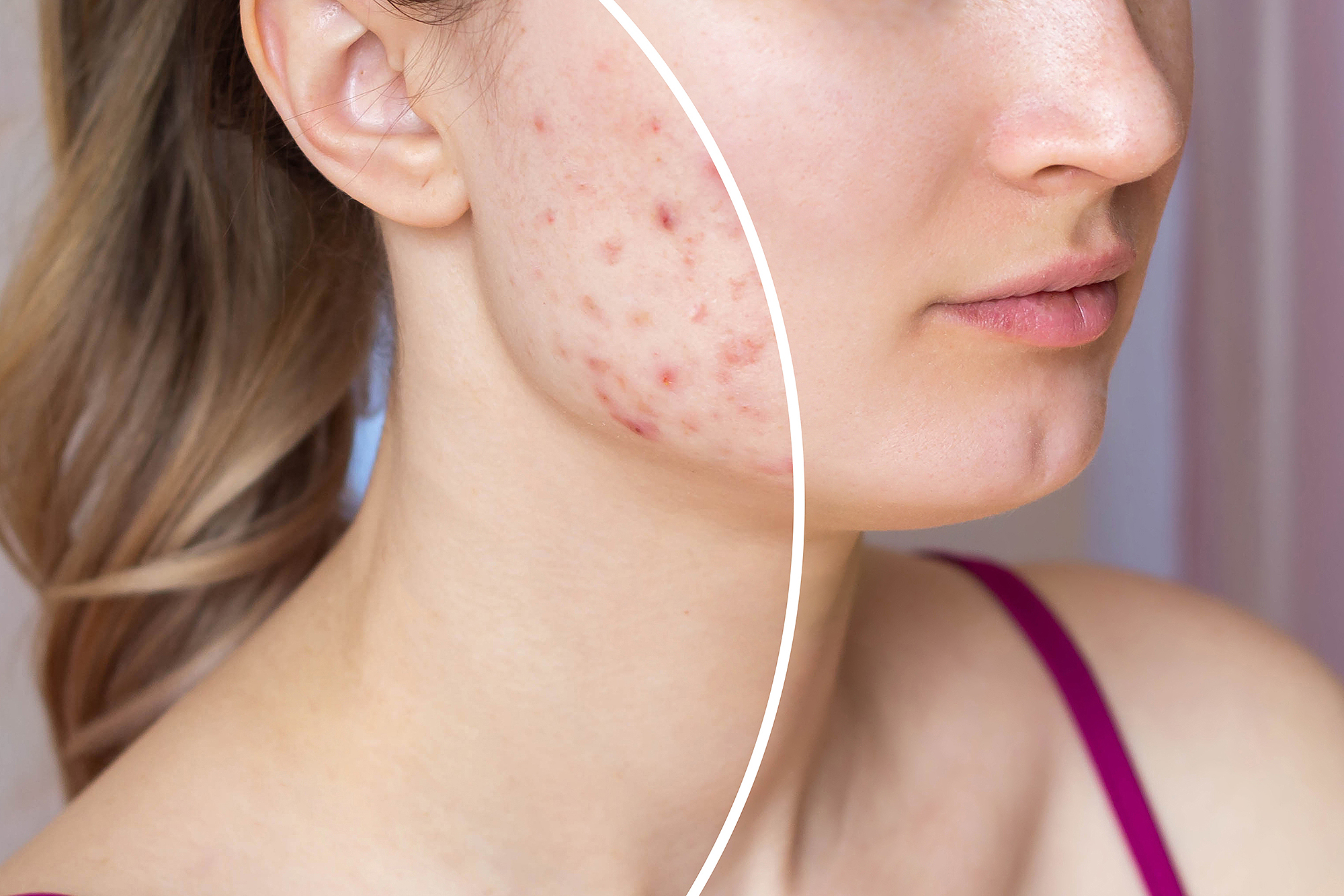 amazon-prime-day-acne-pimple-patches-before-after