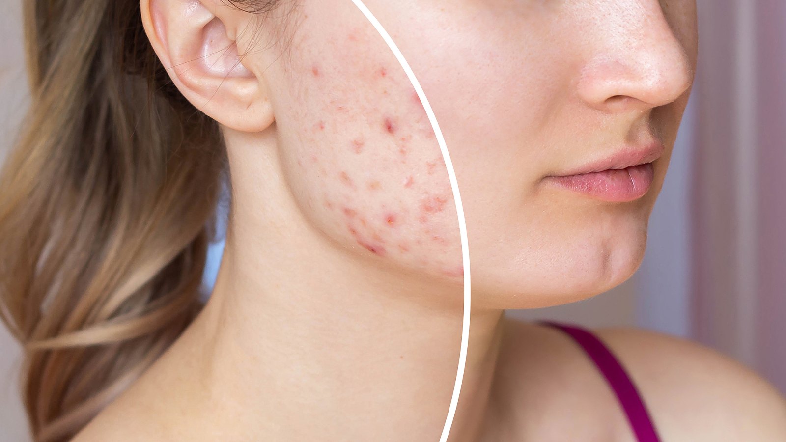 amazon-prime-day-acne-pimple-patches-before-after