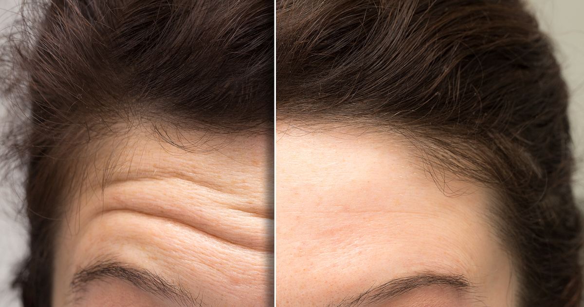 Best Forehead Wrinkle Creams on the Market