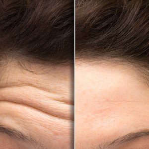 forehead-wrinkle-creams