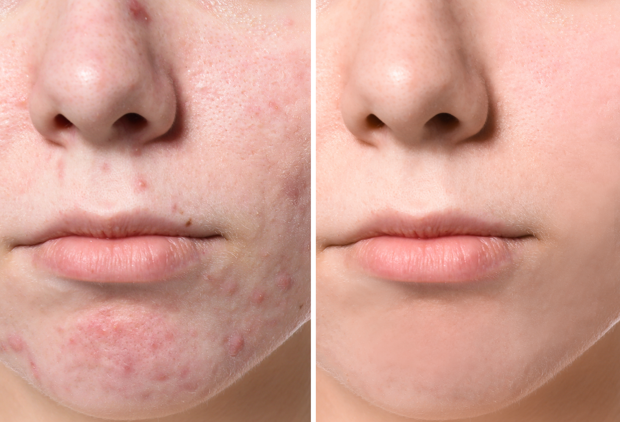 Drmtlgy Cystic Acne Treatment Is a Miracle for So Many Shoppers