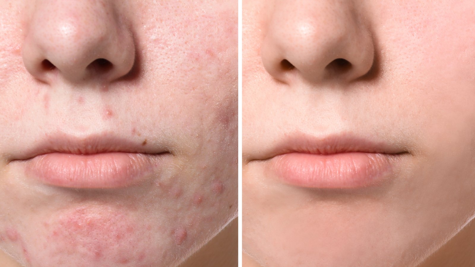 Before-After-Acne-Clear-Skin