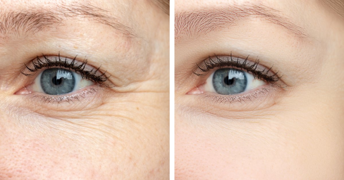 This Tightening Treatment Is Reportedly an Instant Eye Lift in a Tube.jpg