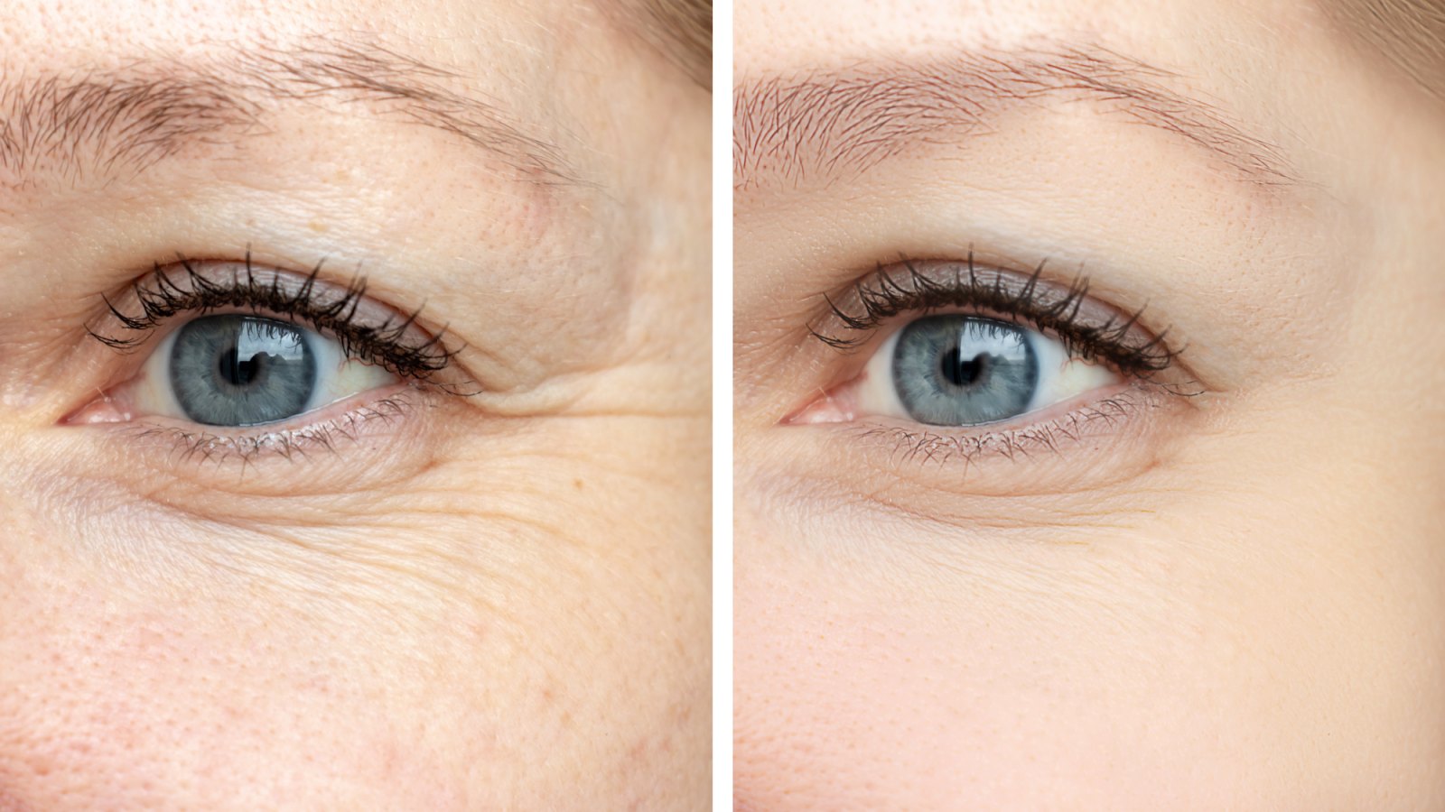 Before-After-Eye-Wrinkles-Stock-Photo