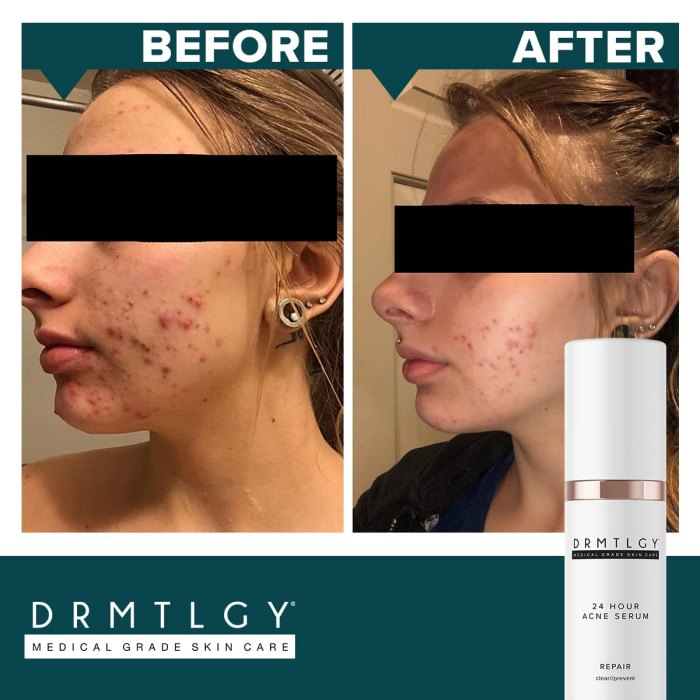 DRMTLGY Treatment of acne spots and cystic acne