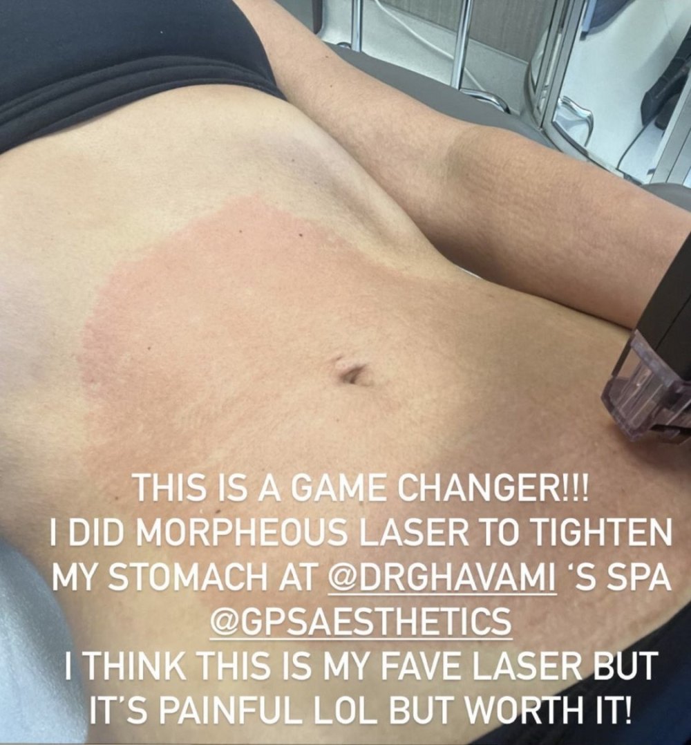 Kim Kardashian Stomach Treatment