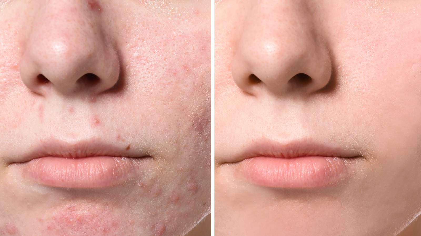 acne-before-after