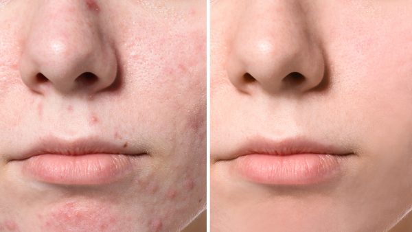 acne-before-after