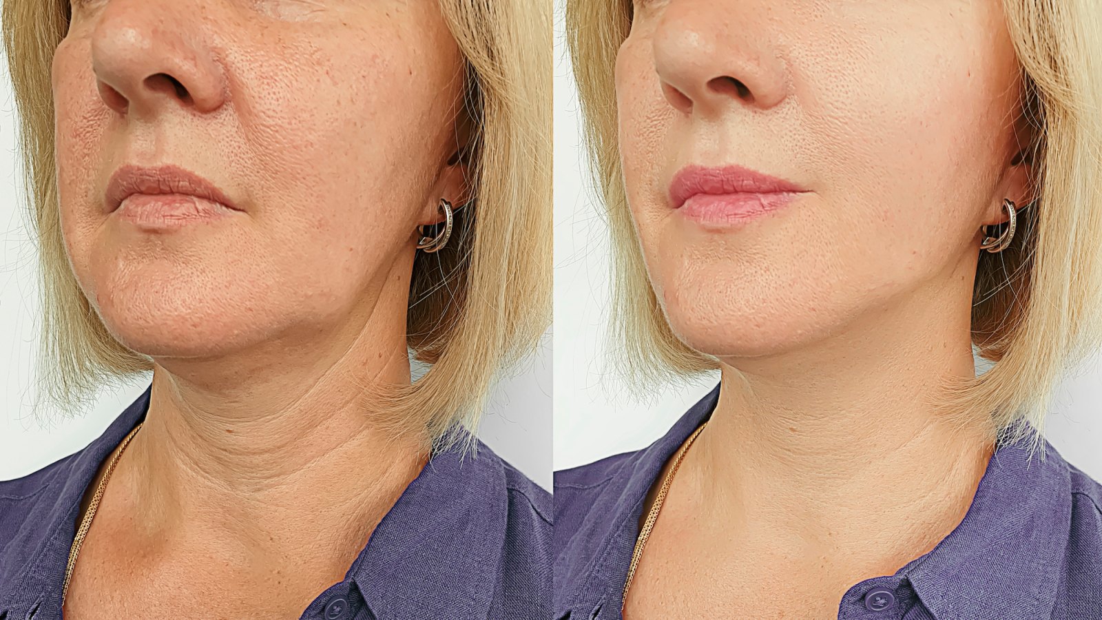 Before-After-Wrinkle-Treatment-Stock-Photo